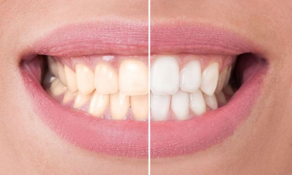 Como realizar o Clareamento Dental Caseiro